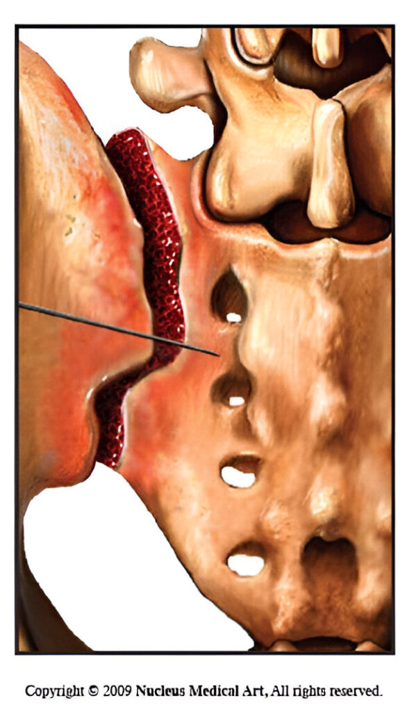 Diagnosis of Sacroiliac Joint Pain