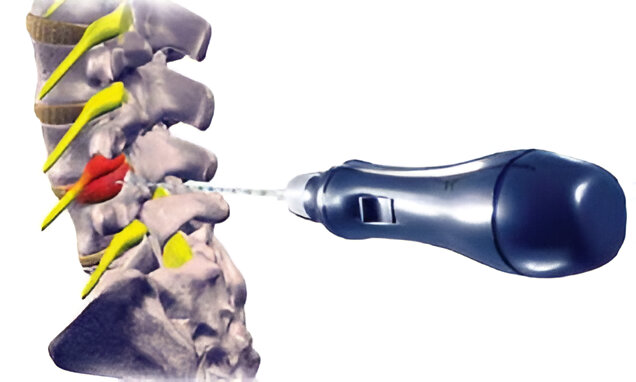 Percutaneous Disc Treatments