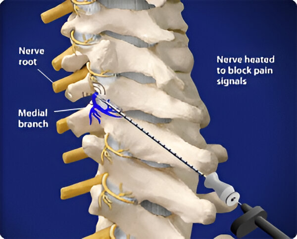 Radiofrequency Ablation Pain