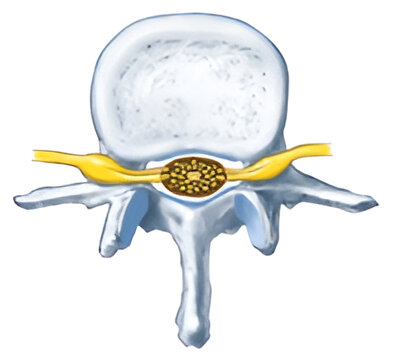 Degenerative spondylolisthesis